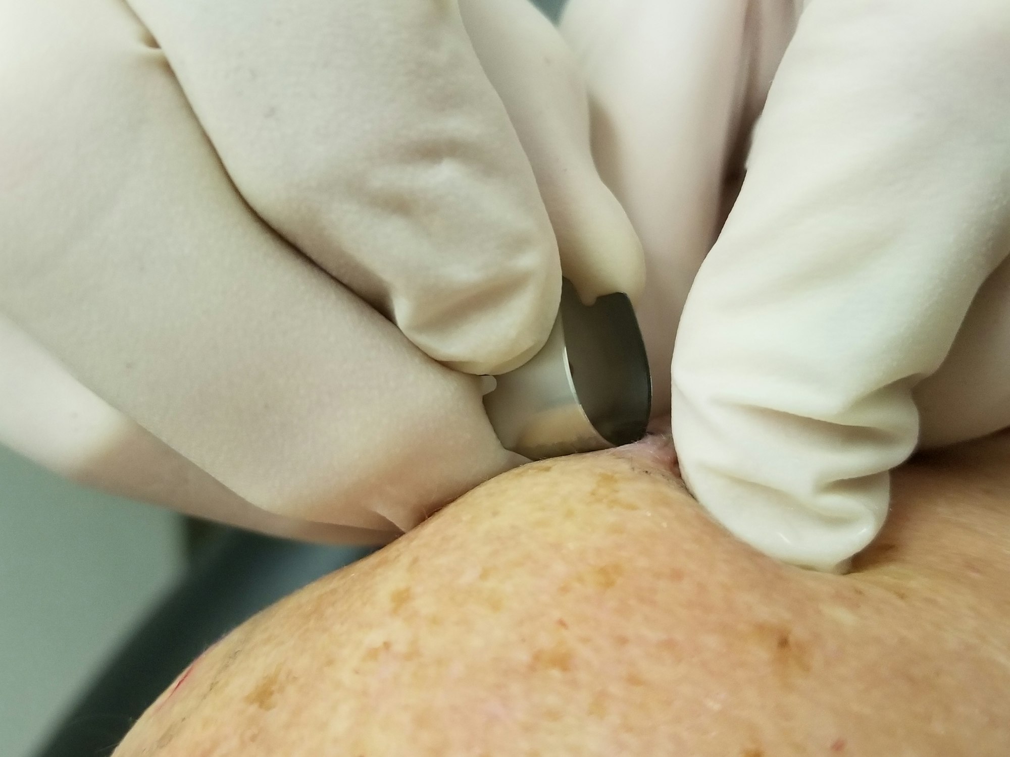 Dermatology Biopsy Using a Razor Blade!